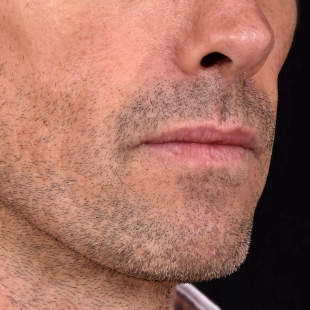 avant-comblement-joues-creuses-dr-barry