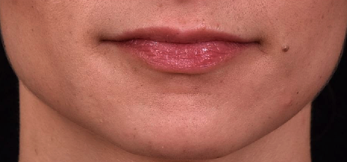 avant-corriger-levres-fines-asymetriques-dr-barry