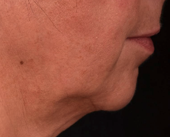 avant-menton-retru-dr-barry