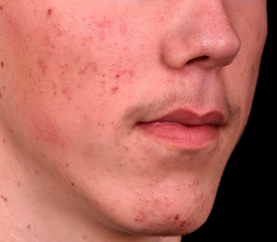 avant-traitement-acne-adolescent-dr-barry