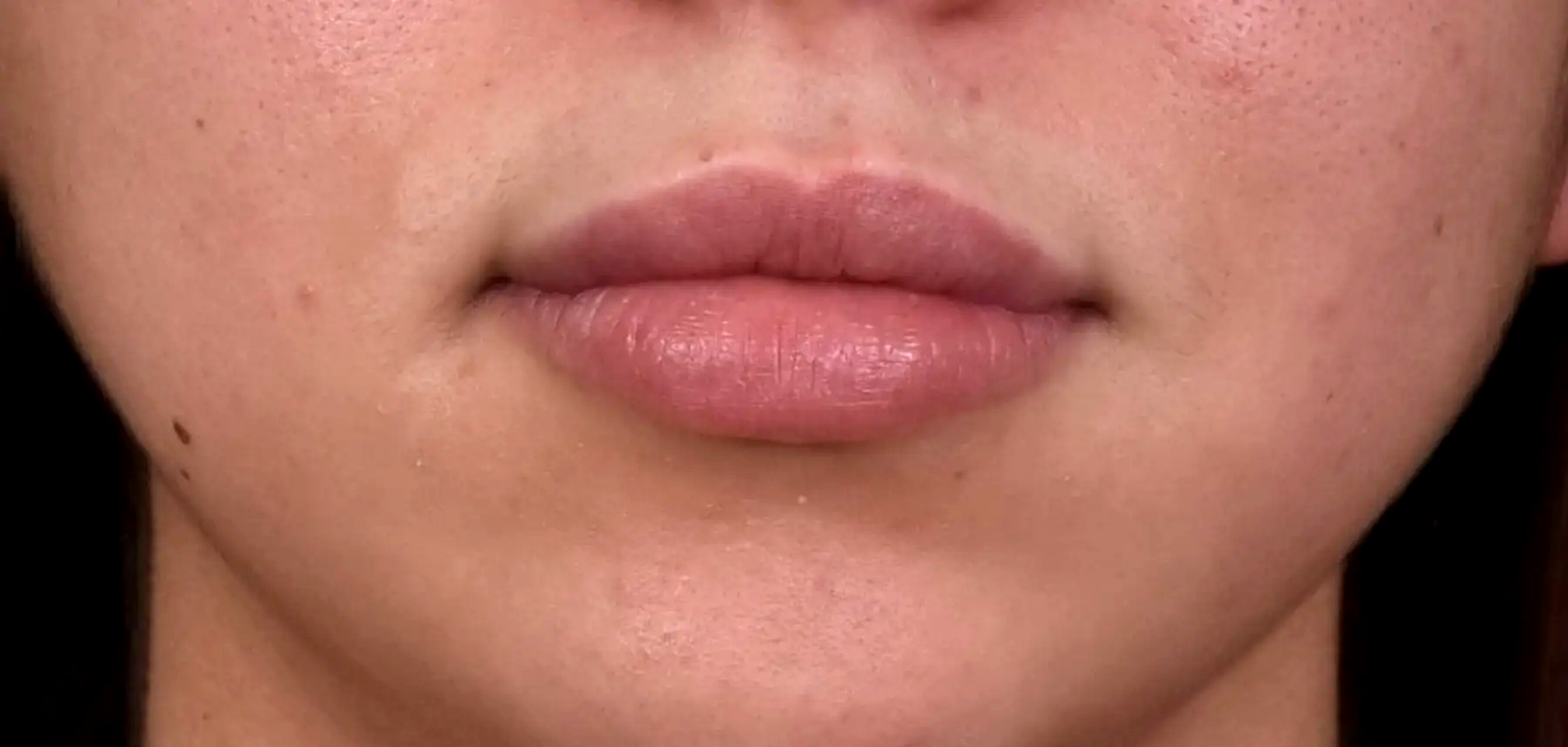 bouche-levre-superieure-trop-fine-apres-dr-barry