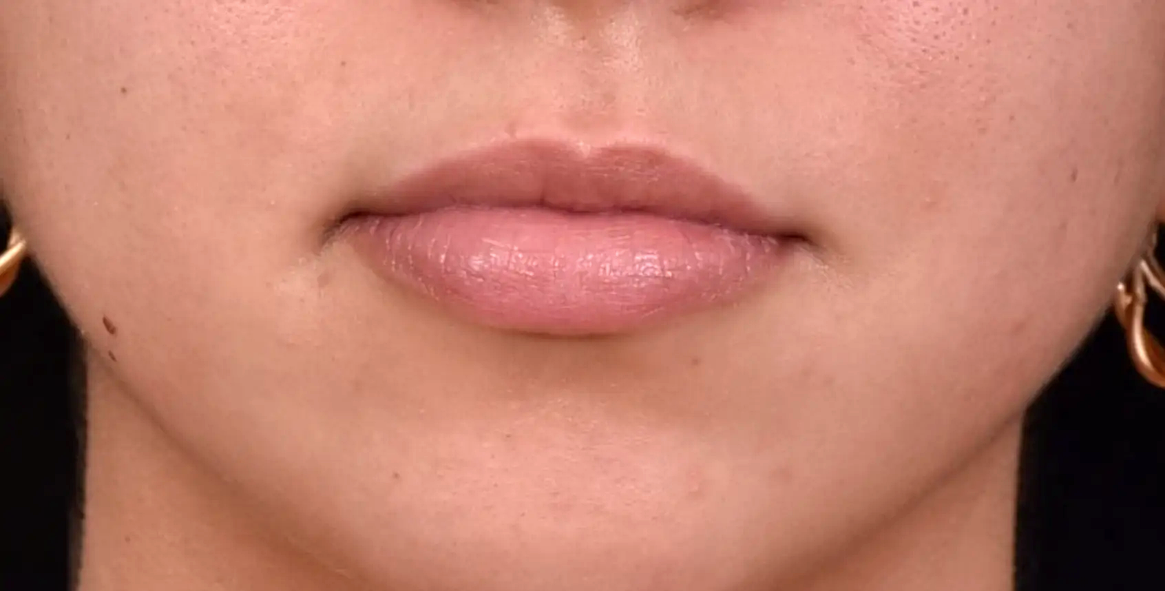 bouche-levre-superieure-trop-fine-avant-dr-barry