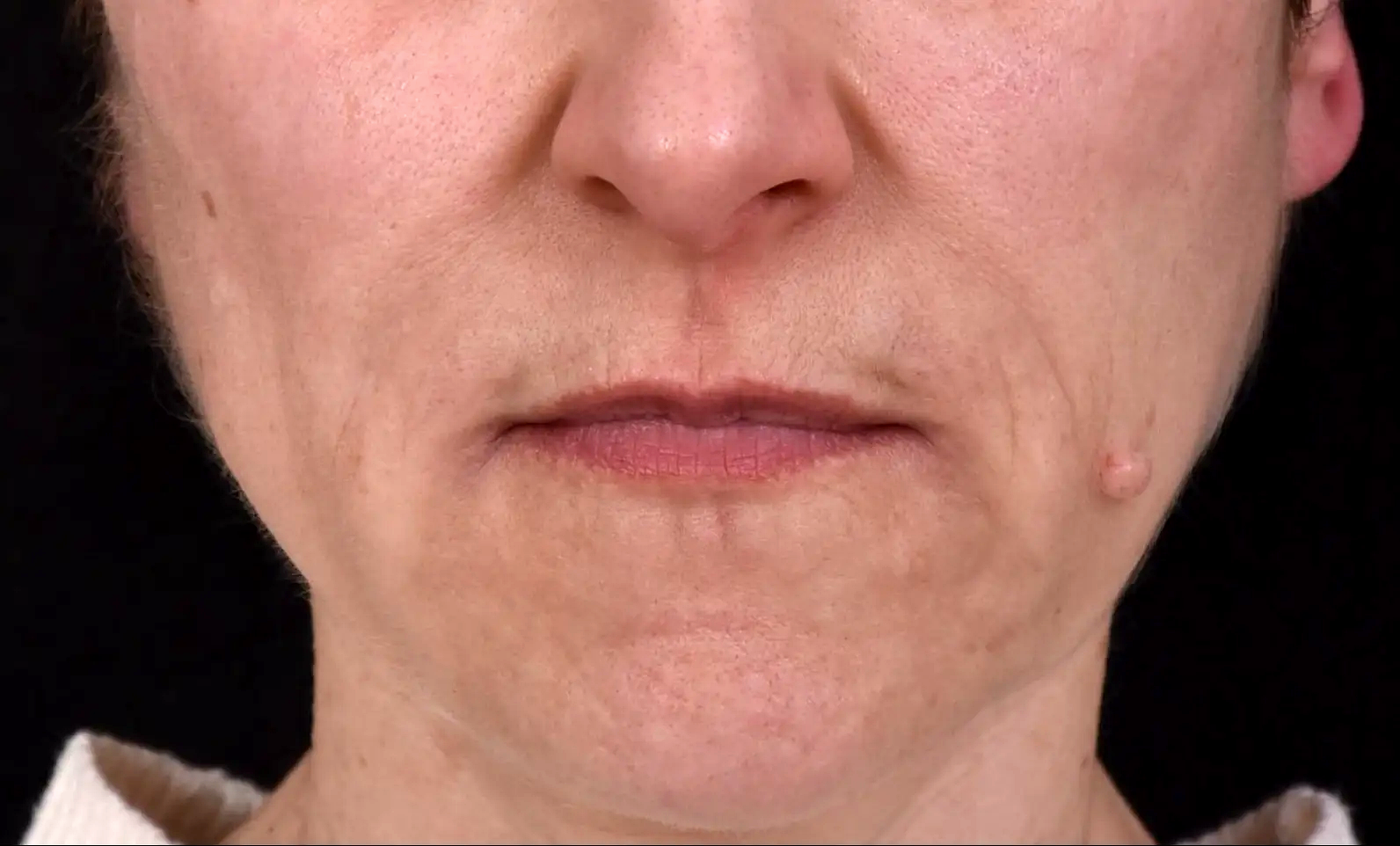 bouche-un-air-severe-apres-dr-barry