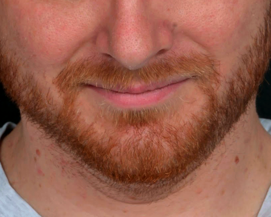 coolsculpting-double-menton-apres-dr-barry