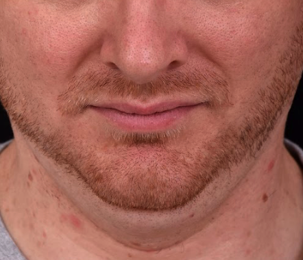 coolsculpting-double-menton-avant-dr-barry