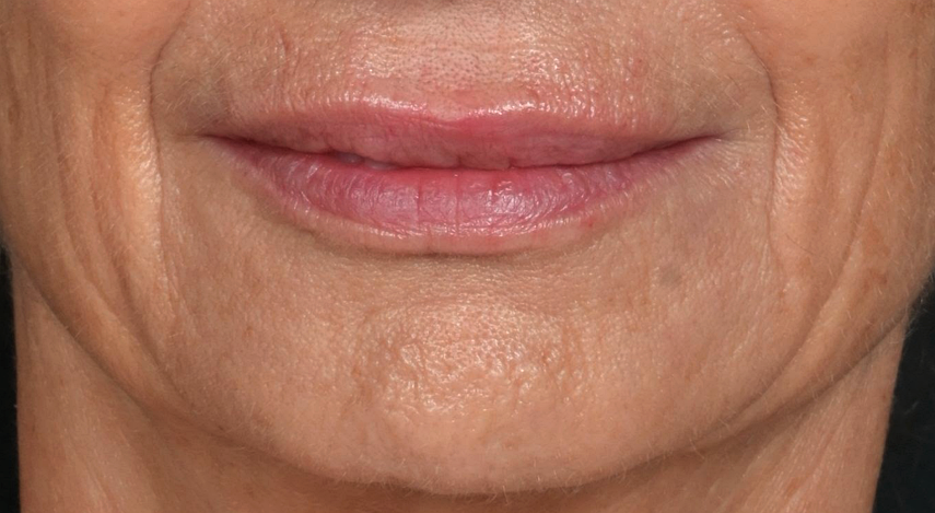 dessin-de-levres-superieur-apres-dr-barry