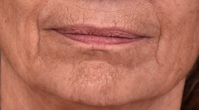 dessin-de-levres-superieur-avant-dr-barry