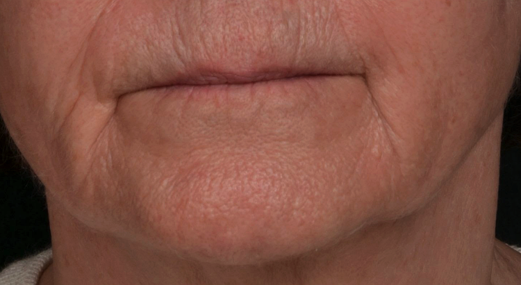 injection-bouche-ah-apres-dr-barry