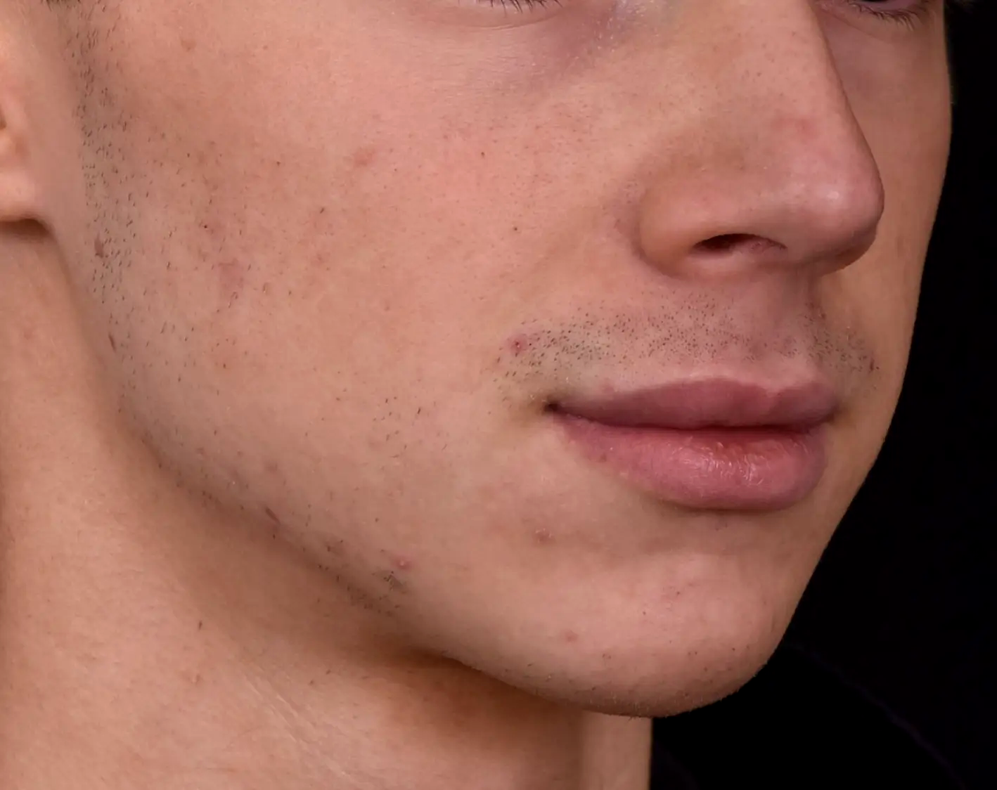 menton-ligne-mandibulaire-redessines-apres-dr-barry