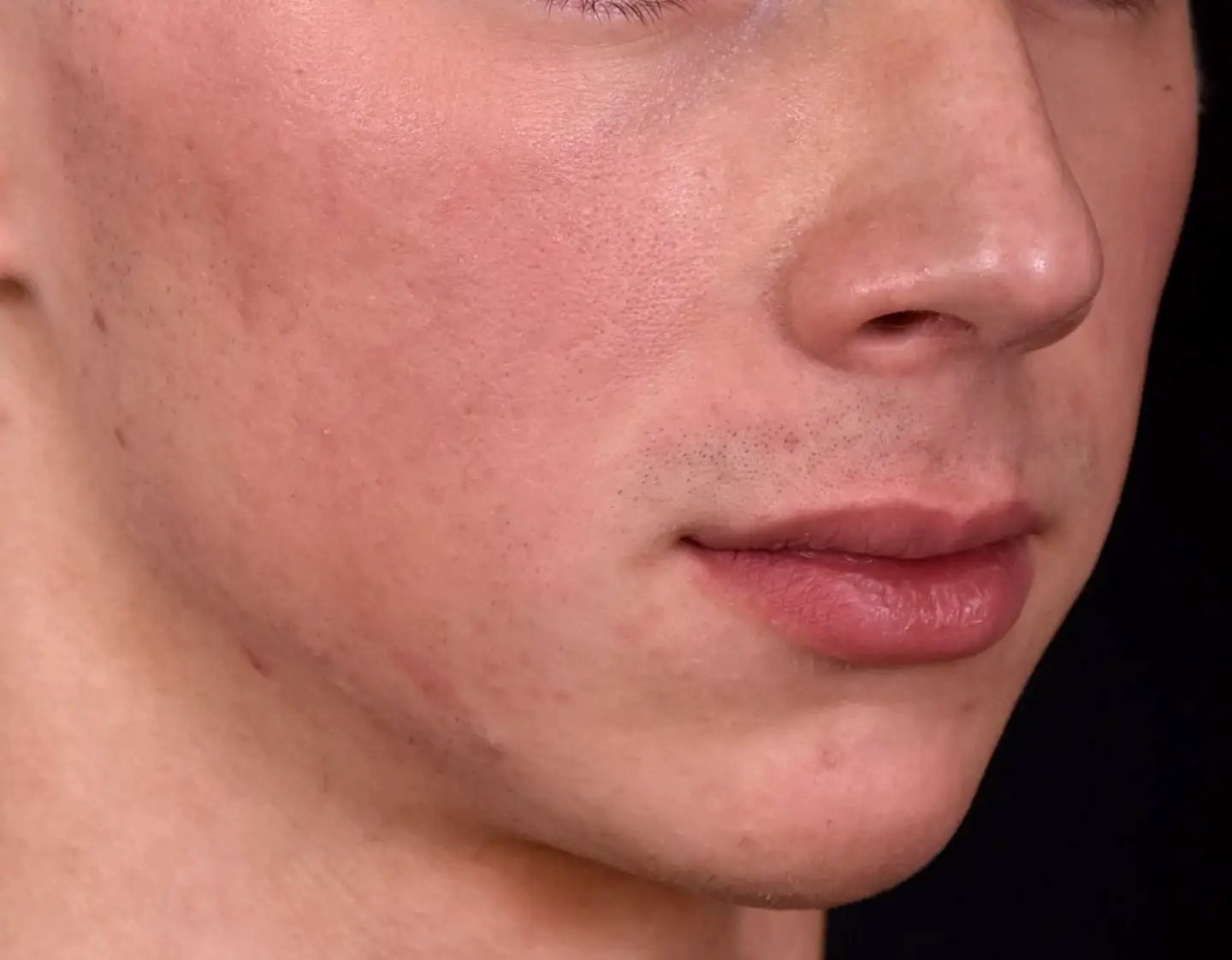 menton-ligne-mandibulaire-redessines-avant-dr-barry