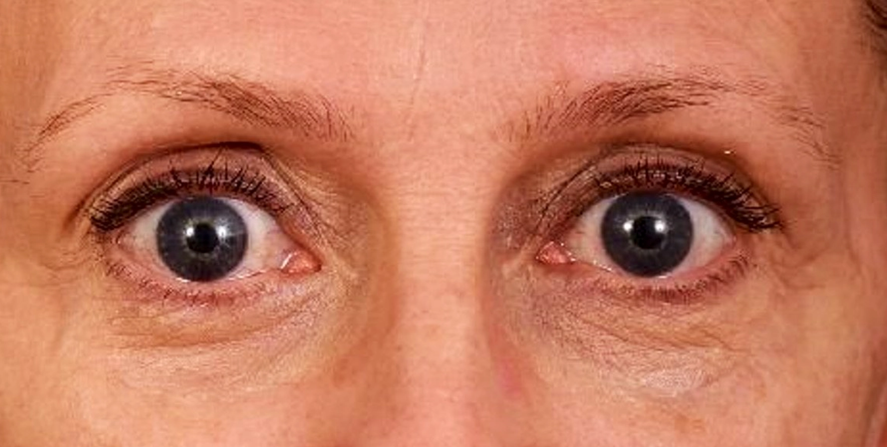 regard-fatigue-apres-dr-barry