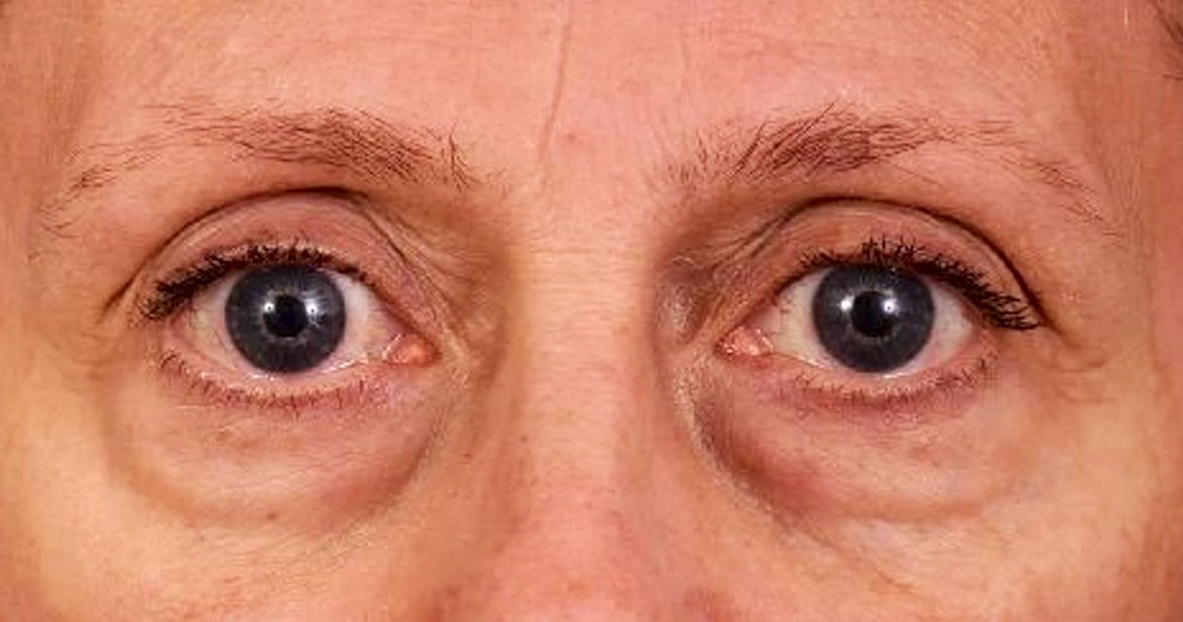 regard-fatigue-avant-dr-barry