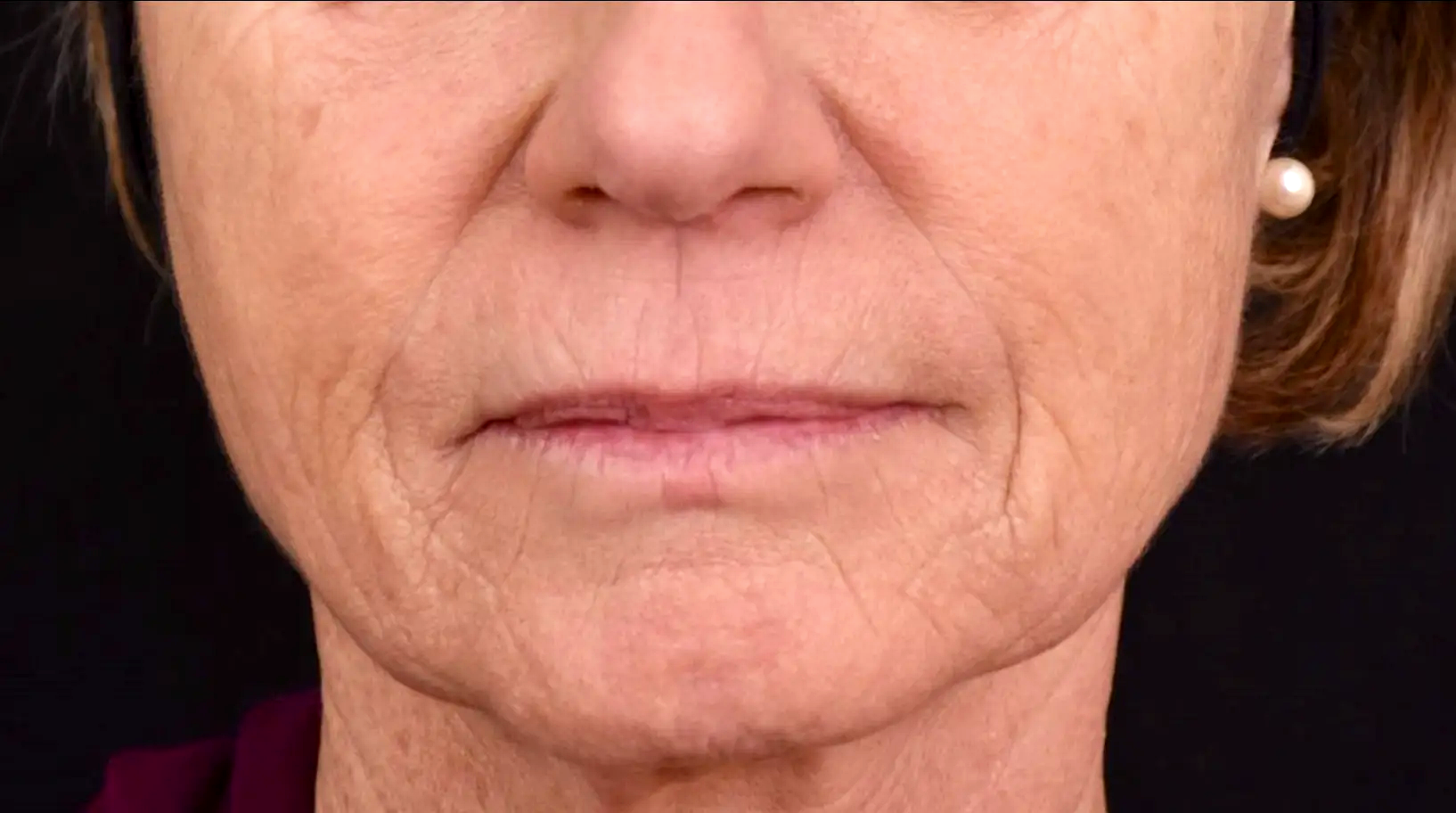 relachement-du-visage-apres-AH-dr-barry